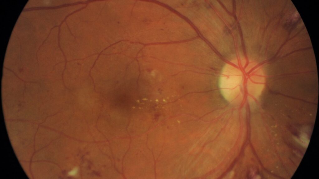 diabete occhi